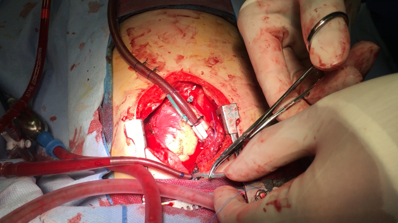 CPR & ECMO in single ventricle patients feat. Ravi Thiagarajan