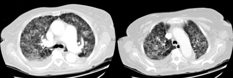 Respiratory Instability – Airways That Scare Me w Robi Khemani