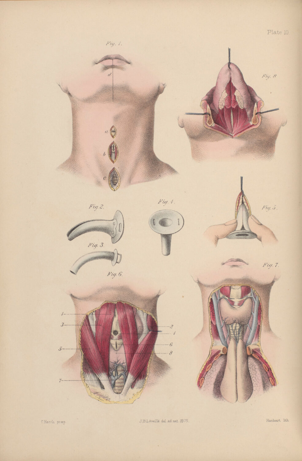 Complex Airway Surgery – Airways That Scare Me